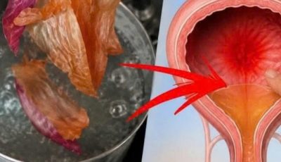 Onion and Onion Skin for Prostate and Bladder Health: Natural Remedies and Precautions