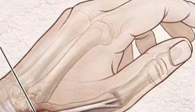 Why Do Your Hands Fall Asleep? Common Causes and Natural Remedies That Actually Work